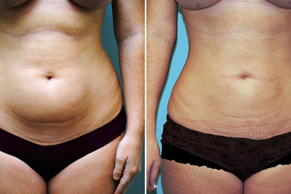 Proven lifestyle changes to trim excess fat from the lower belly region
