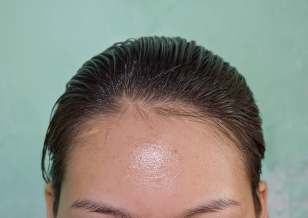 Close-up of a person's oily forehead, highlighting the need for essential products for oily skin types.